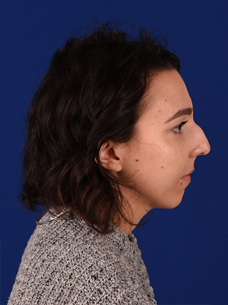 Female Rhinoplasty Before & After Gallery - Patient 17363781 - Image 5