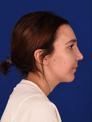 Female Rhinoplasty Before & After Gallery - Patient 17363781 - Image 6