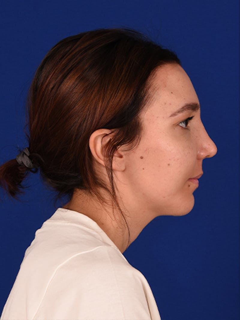 Female Rhinoplasty Before & After Gallery - Patient 17363781 - Image 6