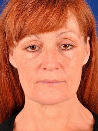 Fat Transfer Face Before & After Gallery - Patient 17363784 - Image 1