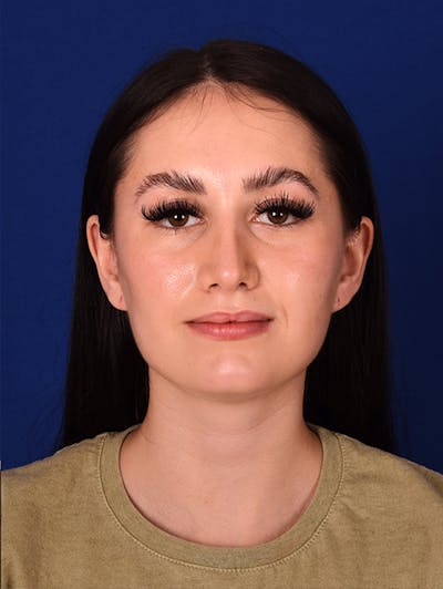 Female Rhinoplasty Before & After Gallery - Patient 17363785 - Image 2