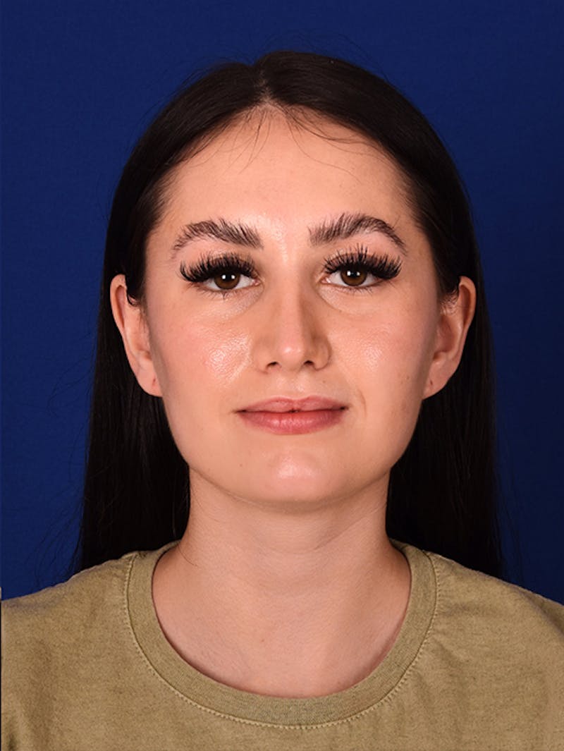 Female Rhinoplasty Before & After Gallery - Patient 17363785 - Image 2