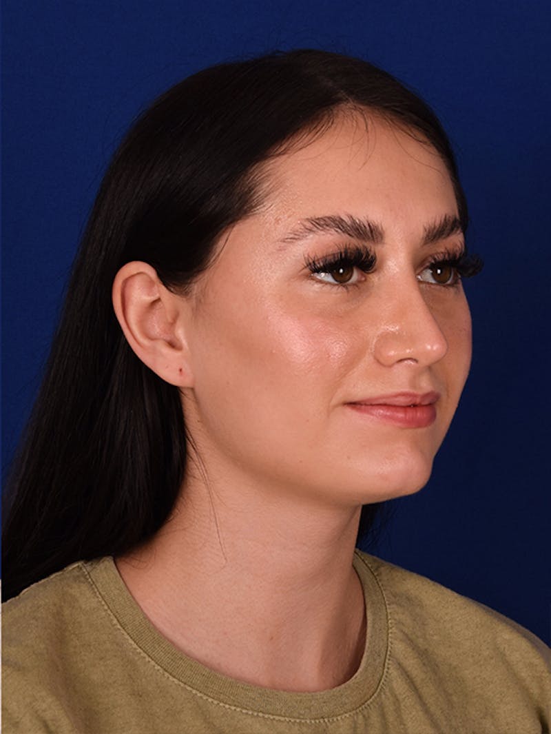 Female Rhinoplasty Before & After Gallery - Patient 17363785 - Image 4