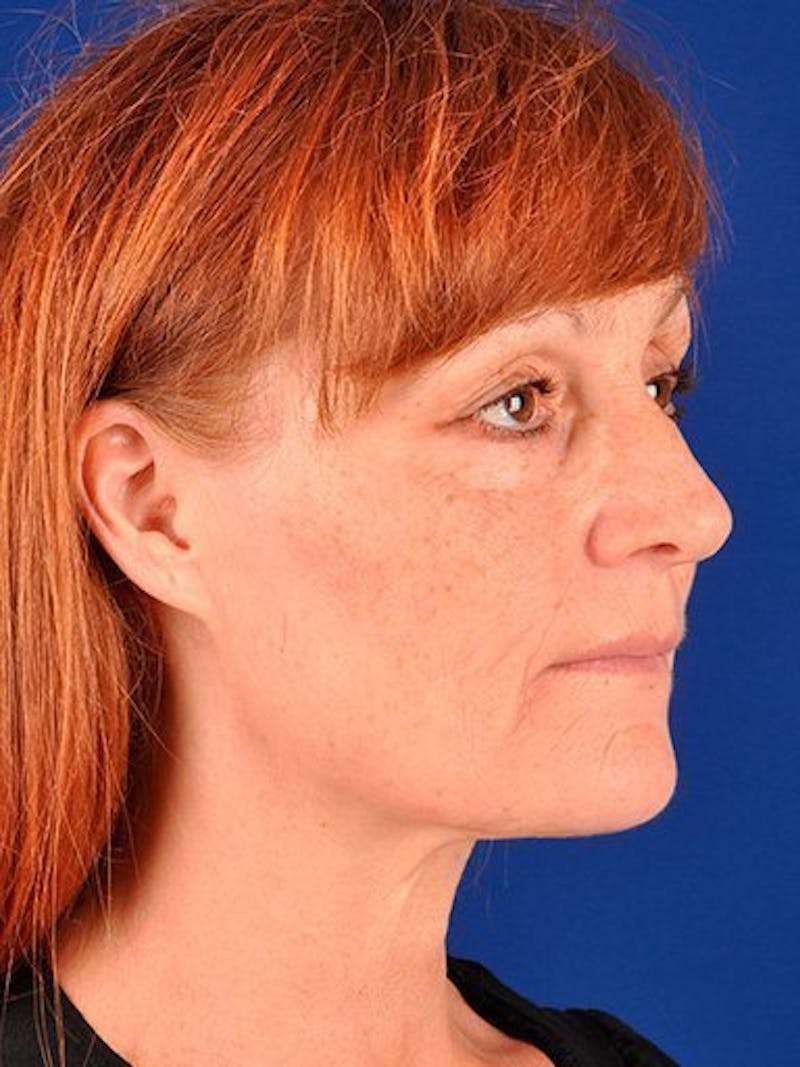 Fat Transfer Face Before & After Gallery - Patient 17363784 - Image 3
