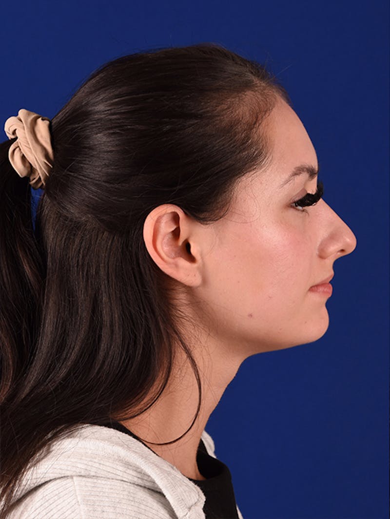 Female Rhinoplasty Before & After Gallery - Patient 17363785 - Image 5