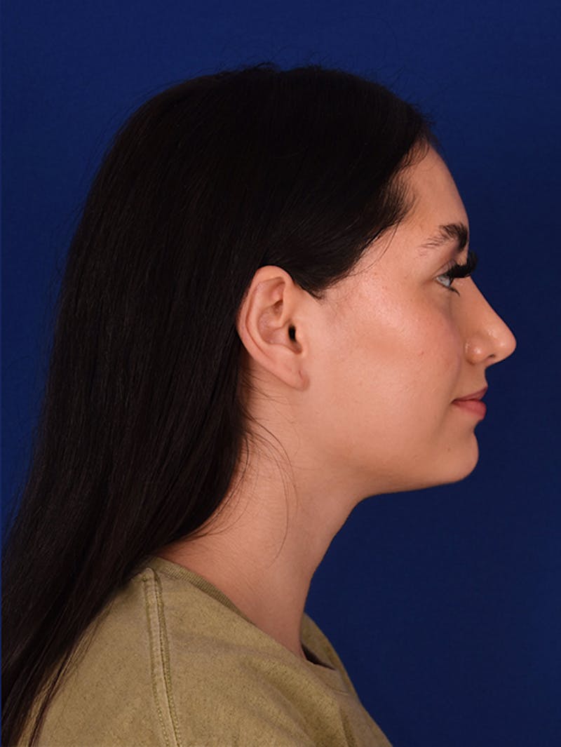 Female Rhinoplasty Before & After Gallery - Patient 17363785 - Image 6