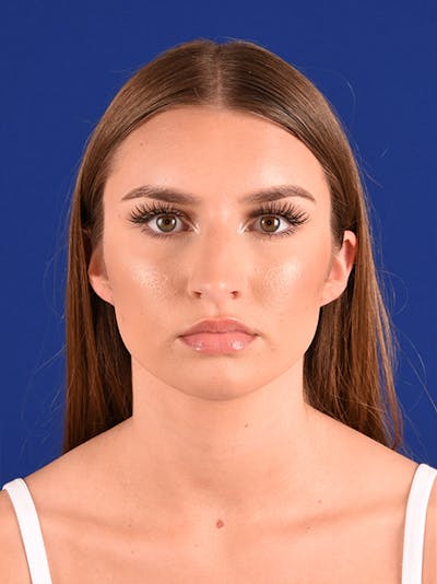 Female Rhinoplasty Before & After Gallery - Patient 17363804 - Image 1