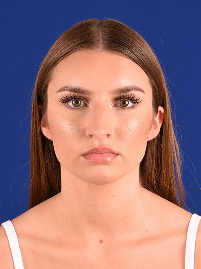 Female Rhinoplasty Before & After Gallery - Patient 17363804 - Image 1