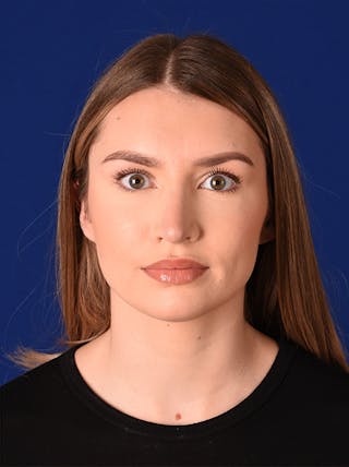 Female Rhinoplasty Before & After Gallery - Patient 17363804 - Image 2