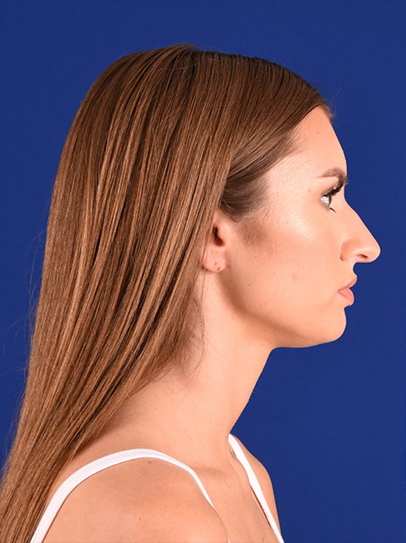 Female Rhinoplasty Before & After Gallery - Patient 17363804 - Image 5