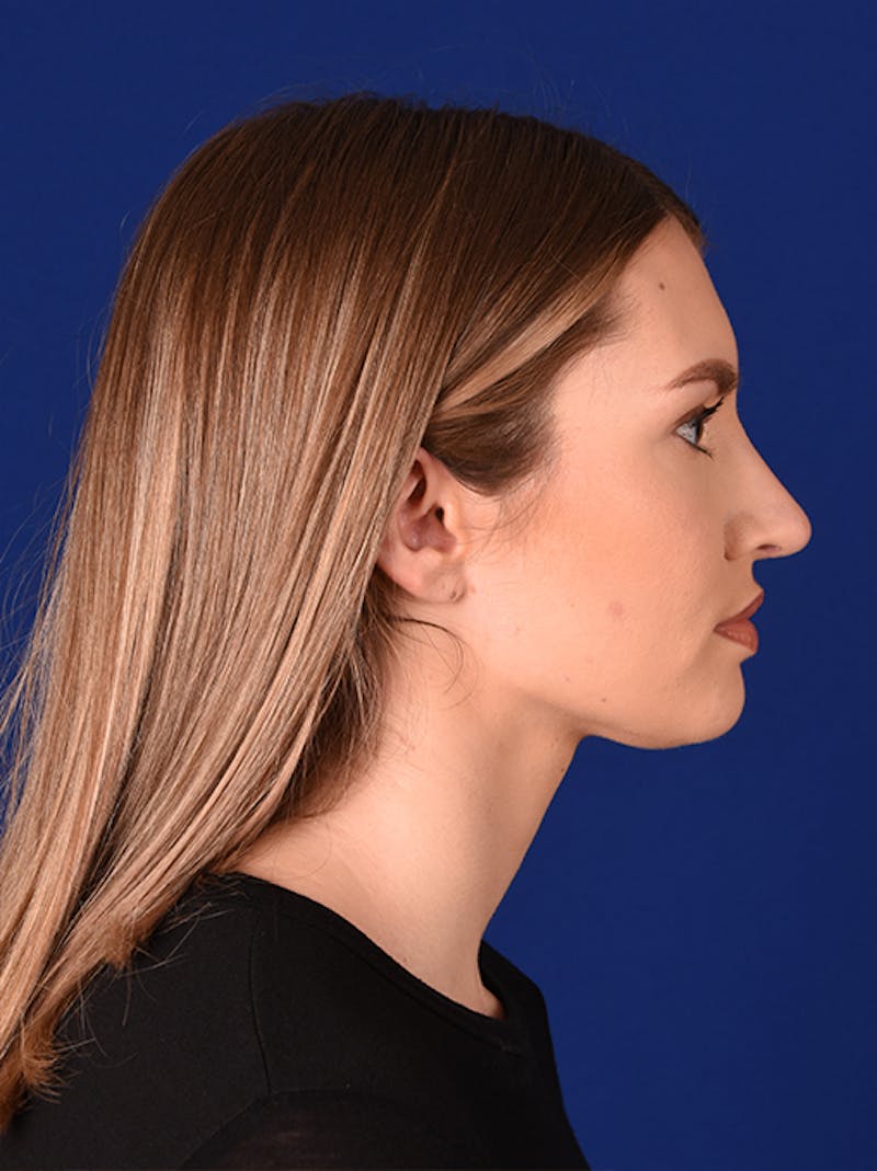 Female Rhinoplasty Before & After Gallery - Patient 17363804 - Image 6