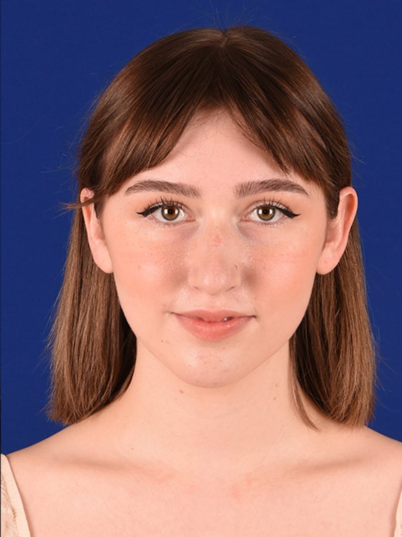 Female Rhinoplasty Before & After Gallery - Patient 17363806 - Image 1