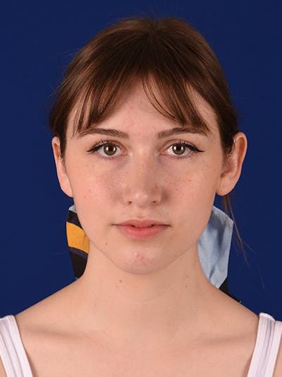 Female Rhinoplasty Before & After Gallery - Patient 17363806 - Image 2