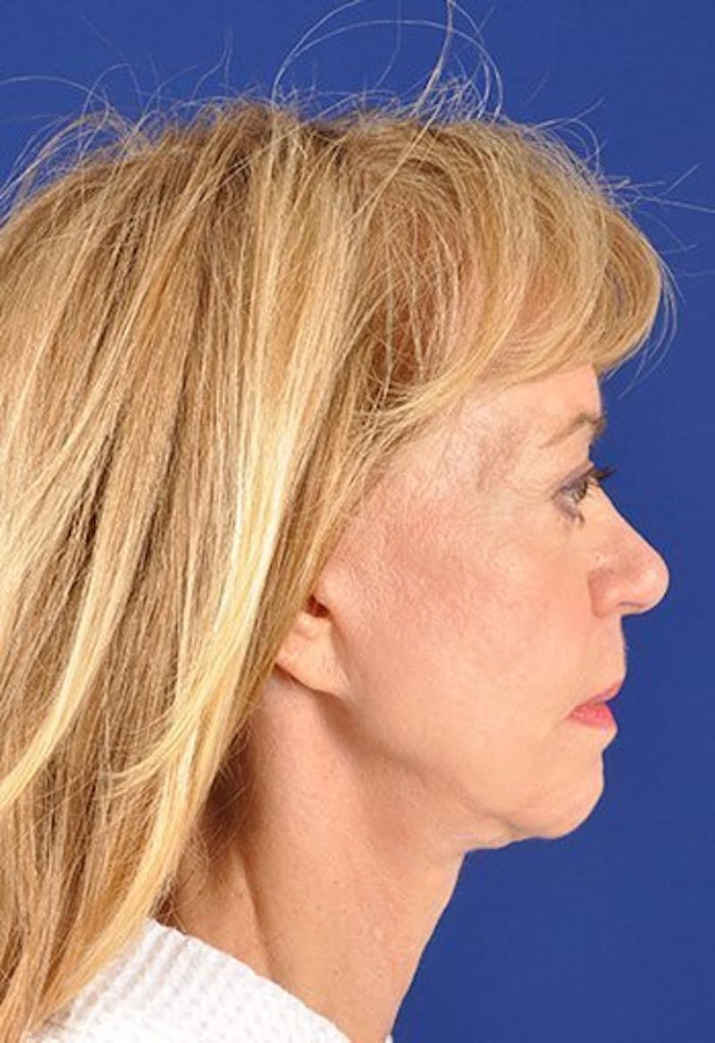 Fat Transfer Face Before & After Gallery - Patient 17363805 - Image 5