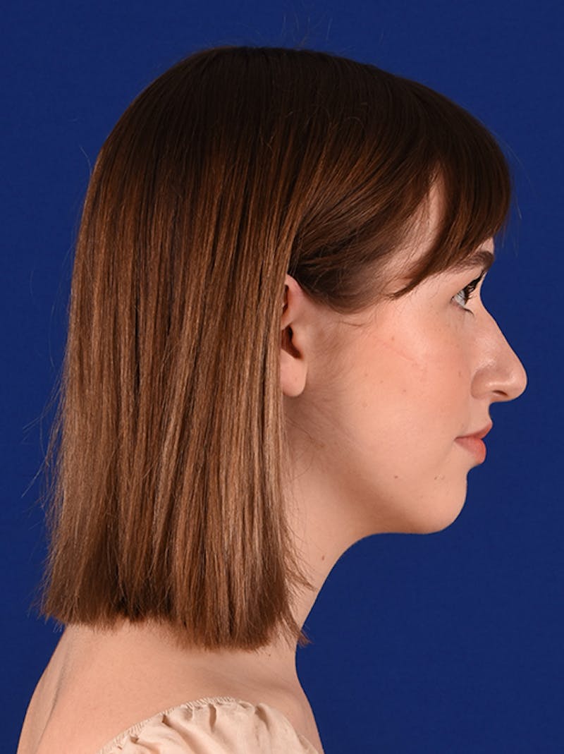 Female Rhinoplasty Before & After Gallery - Patient 17363806 - Image 5