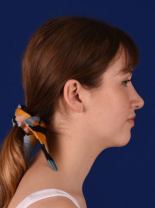 Female Rhinoplasty Before & After Gallery - Patient 17363806 - Image 6