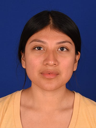 Female Rhinoplasty Before & After Gallery - Patient 17363810 - Image 1