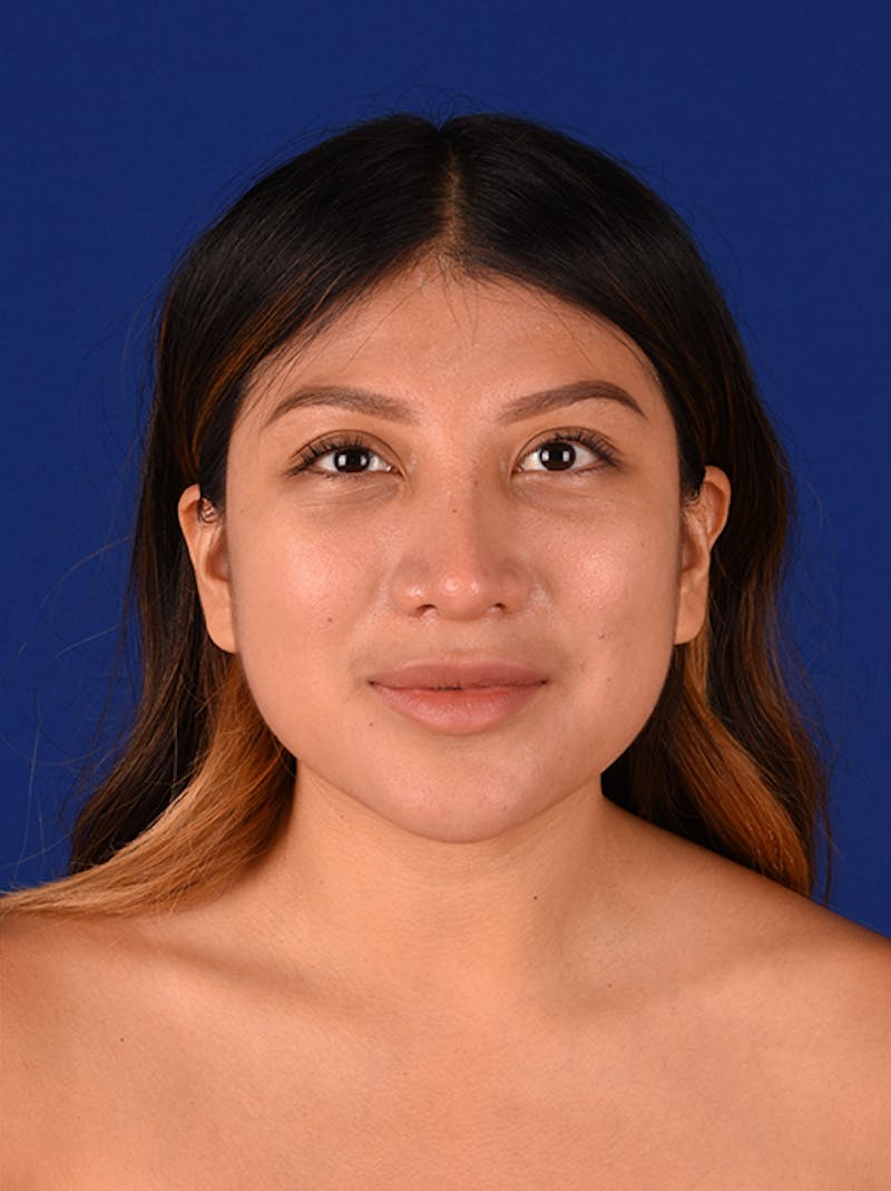 Female Rhinoplasty Before & After Gallery - Patient 17363810 - Image 2