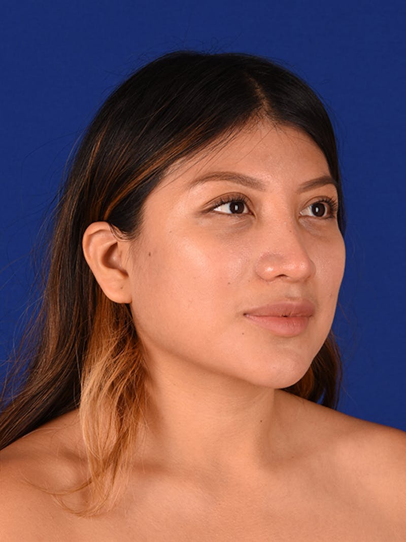 Female Rhinoplasty Before & After Gallery - Patient 17363810 - Image 4