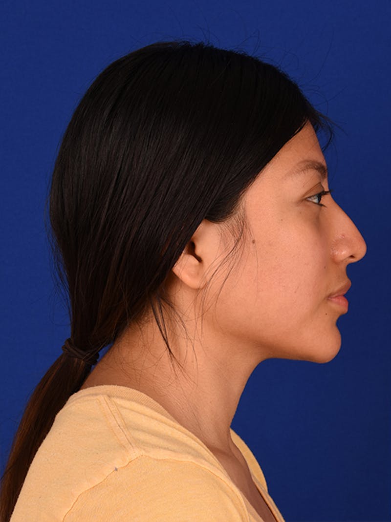 Female Rhinoplasty Before & After Gallery - Patient 17363810 - Image 5