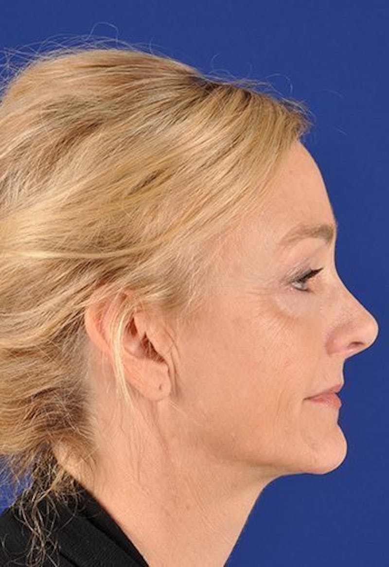 Fat Transfer Face Before & After Gallery - Patient 17363809 - Image 3