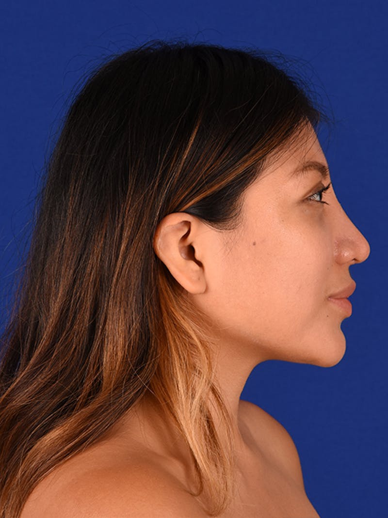Female Rhinoplasty Before & After Gallery - Patient 17363810 - Image 6
