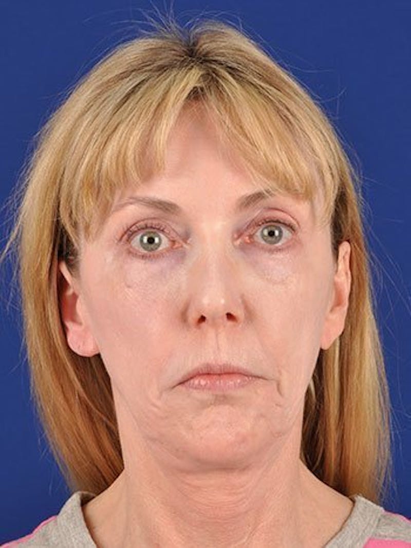 Fat Transfer Face Before & After Gallery - Patient 17363811 - Image 1