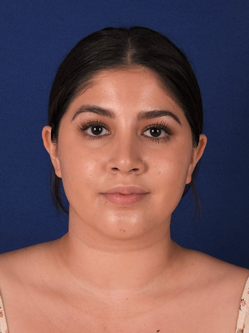 Female Rhinoplasty Before & After Gallery - Patient 17363813 - Image 2