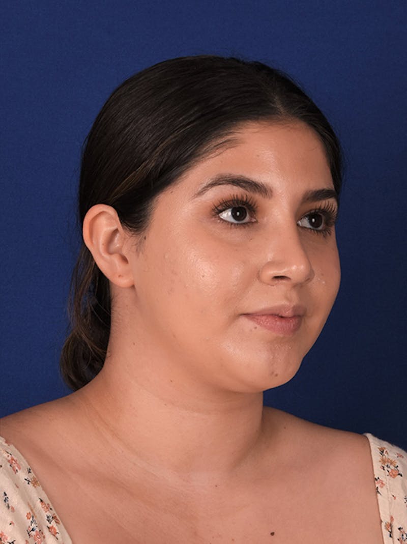 Female Rhinoplasty Before & After Gallery - Patient 17363813 - Image 4