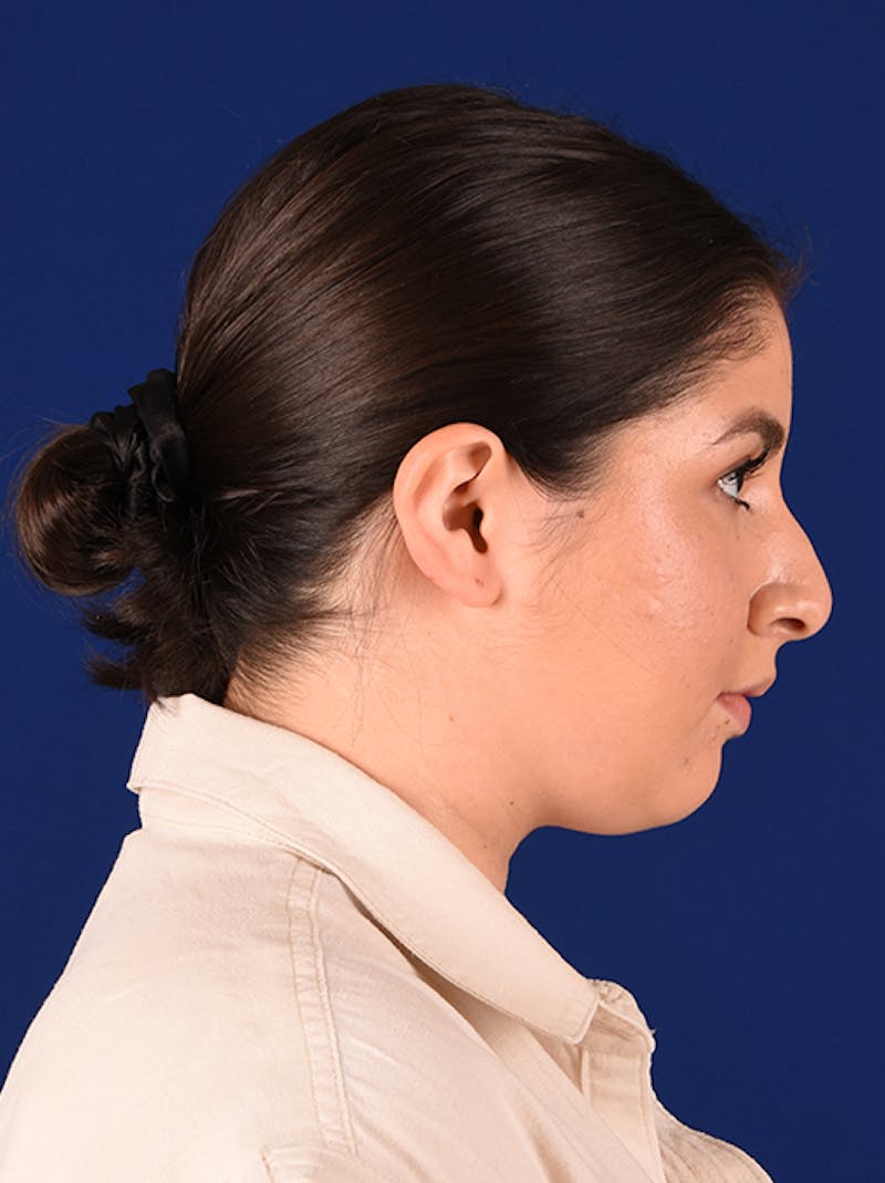 Female Rhinoplasty Before & After Gallery - Patient 17363813 - Image 5