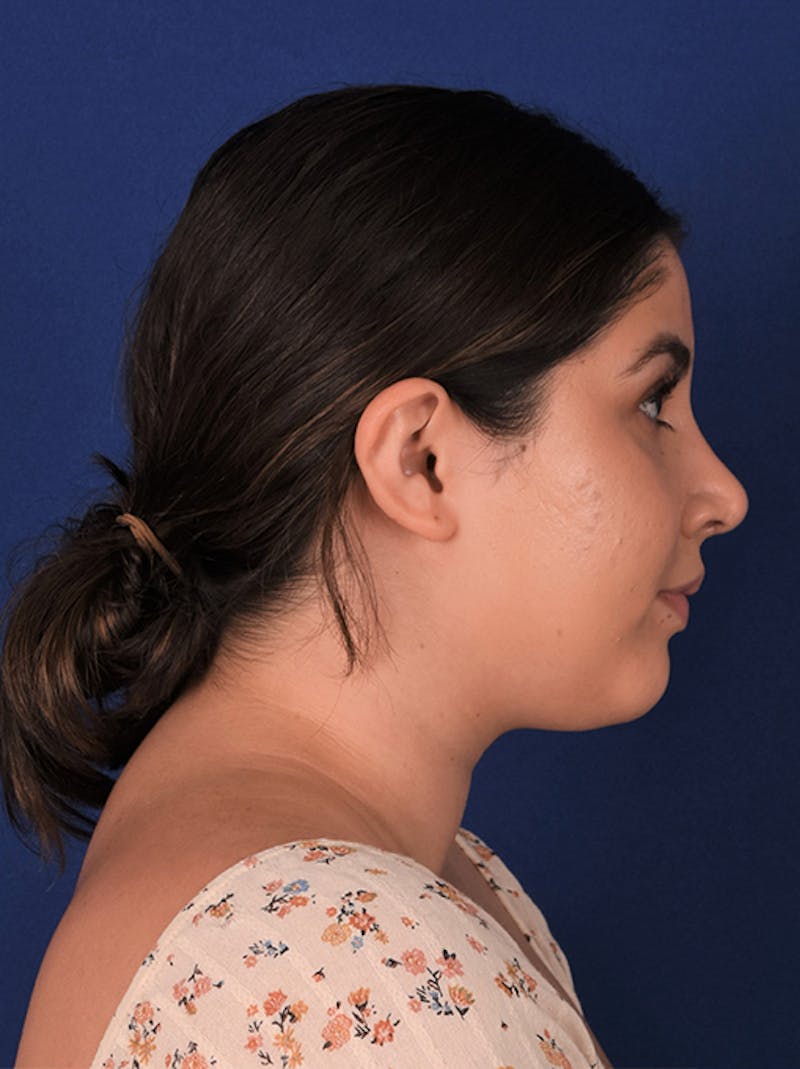 Female Rhinoplasty Before & After Gallery - Patient 17363813 - Image 6