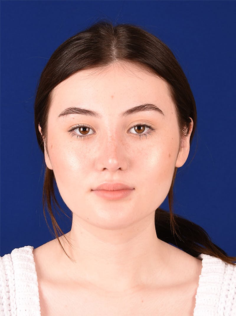 Female Rhinoplasty Before & After Gallery - Patient 17363815 - Image 2