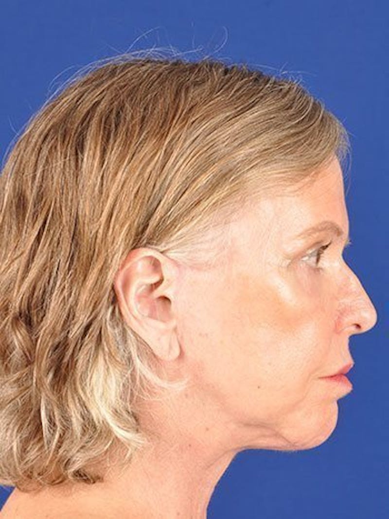 Fat Transfer Face Before & After Gallery - Patient 17363814 - Image 4