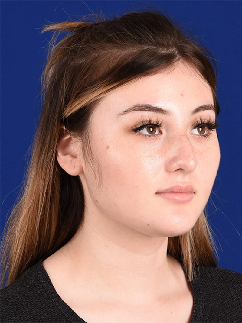 Female Rhinoplasty Before & After Gallery - Patient 17363815 - Image 3