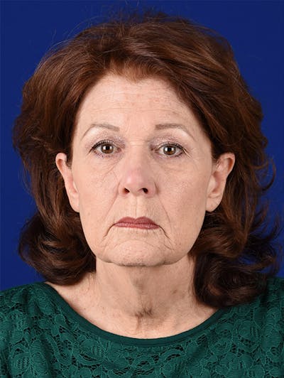 Fat Transfer Face Before & After Gallery - Patient 17363816 - Image 1