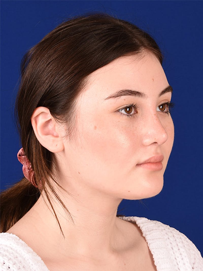 Female Rhinoplasty Before & After Gallery - Patient 17363815 - Image 4