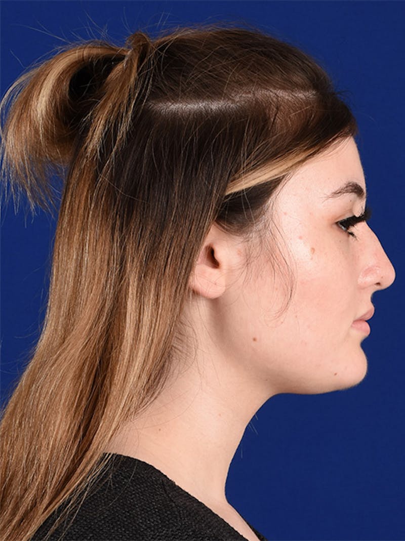 Female Rhinoplasty Before & After Gallery - Patient 17363815 - Image 5