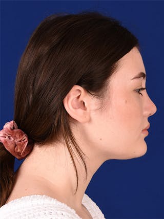 Female Rhinoplasty Before & After Gallery - Patient 17363815 - Image 6