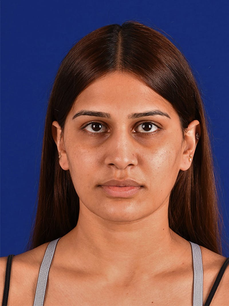 Female Rhinoplasty Before & After Gallery - Patient 17363818 - Image 1