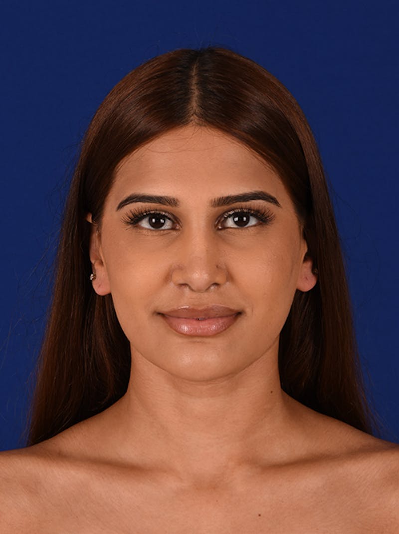 Female Rhinoplasty Before & After Gallery - Patient 17363818 - Image 2