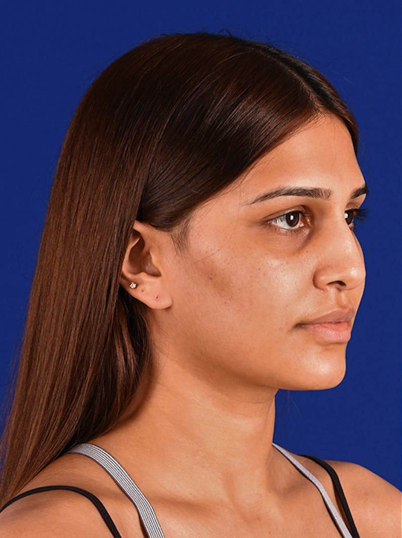 Female Rhinoplasty Before & After Gallery - Patient 17363818 - Image 3