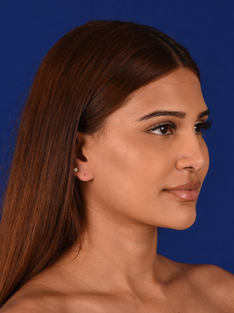 Female Rhinoplasty Before & After Gallery - Patient 17363818 - Image 4