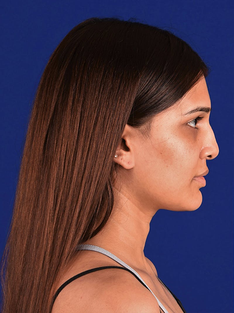 Female Rhinoplasty Before & After Gallery - Patient 17363818 - Image 5