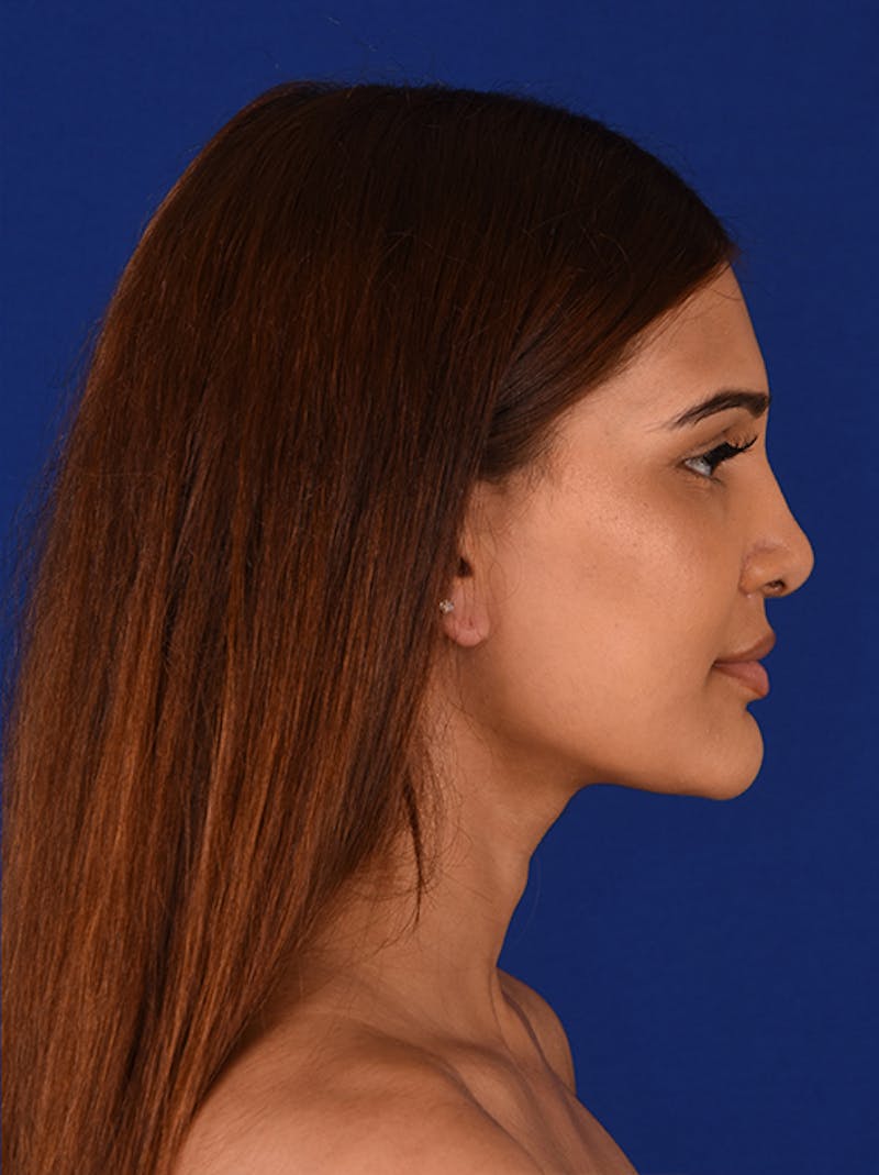 Female Rhinoplasty Before & After Gallery - Patient 17363818 - Image 6