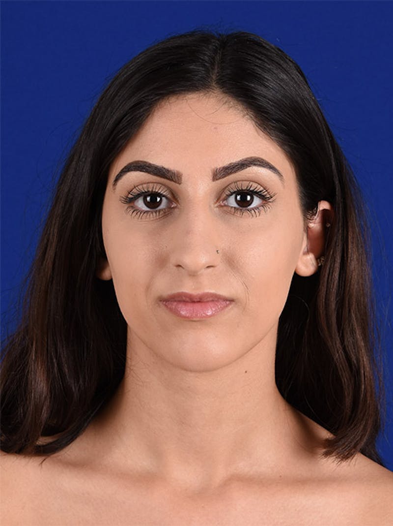 Female Rhinoplasty Before & After Gallery - Patient 17363819 - Image 1