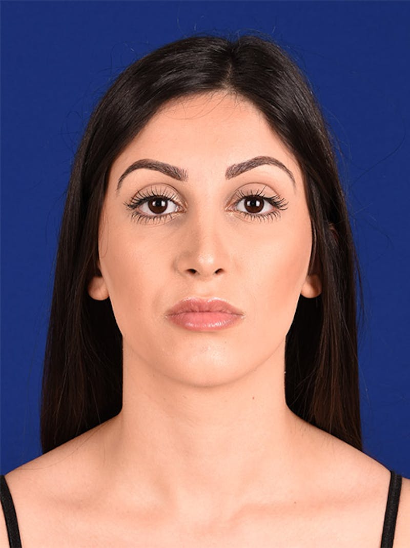 Female Rhinoplasty Before & After Gallery - Patient 17363819 - Image 2