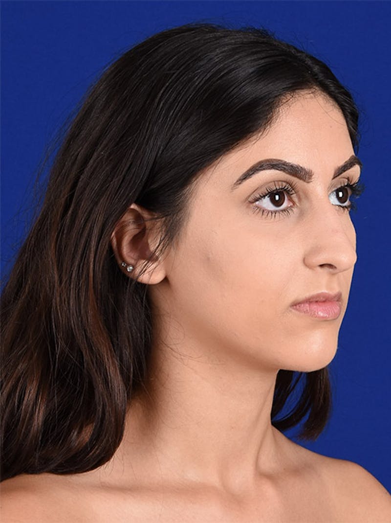 Female Rhinoplasty Before & After Gallery - Patient 17363819 - Image 3