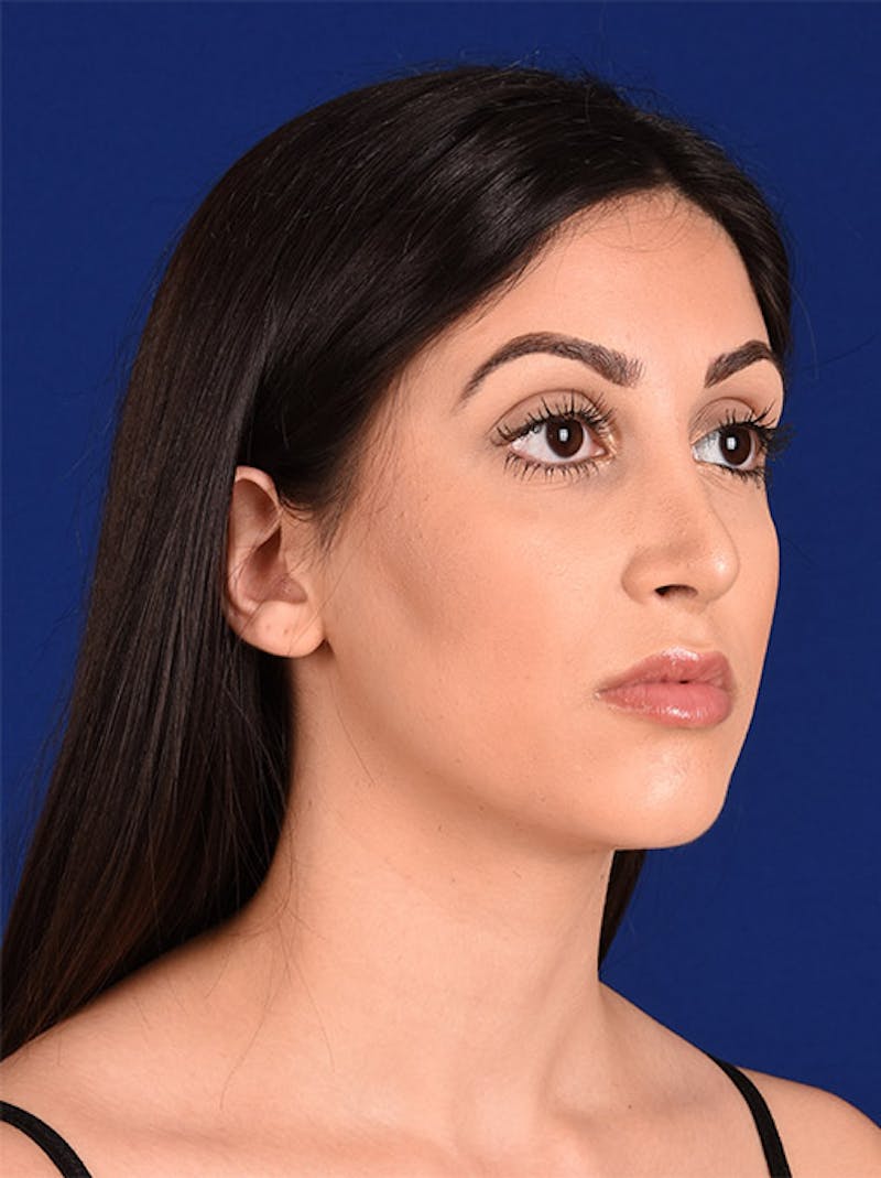 Female Rhinoplasty Before & After Gallery - Patient 17363819 - Image 4