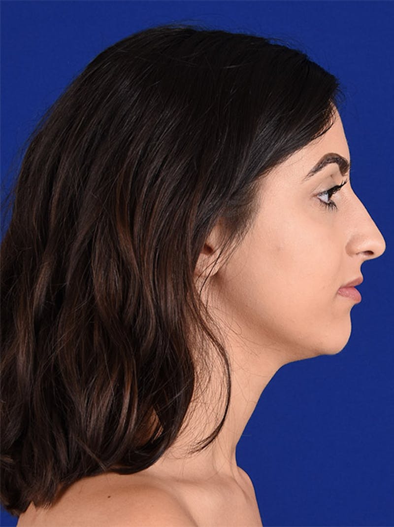 Female Rhinoplasty Before & After Gallery - Patient 17363819 - Image 5