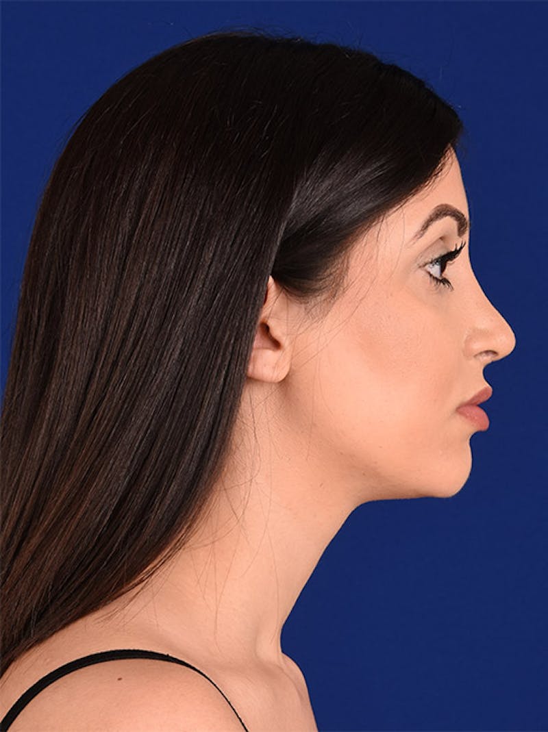 Female Rhinoplasty Before & After Gallery - Patient 17363819 - Image 6